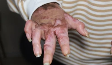 Kalfalık eğitimi sırasında meydana gelen kazada yüzde 80’i yanan lise öğrencisi 15 ameliyat geçirdi