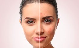 Akne Skarı Tedavisi – Dr. Suada Gasimova