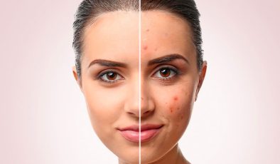 Akne Skarı Tedavisi – Dr. Suada Gasimova