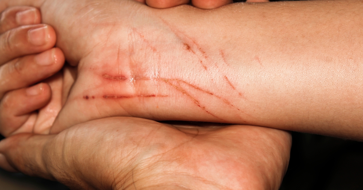 Kuduz ne zaman ölümcül? Uzmanlardan kritik uyarılar