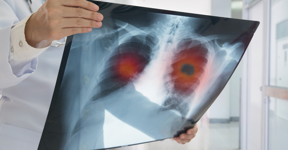 Verem ilacını aksatmayana 9 bin lira