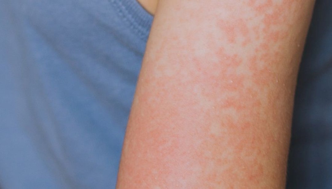 Kızamık vakaları artıyor: Teksas’ta 48 vaka tespit edildi